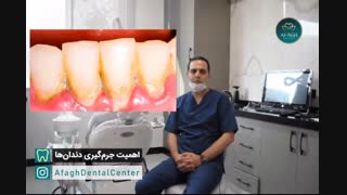 جرمگیری دندان