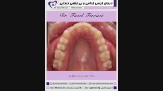 درمان کراس بایت قدامی و بی نظمی دندانی | دکتر فیروزی
