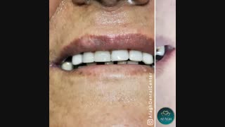 ونیر کامپوزیت