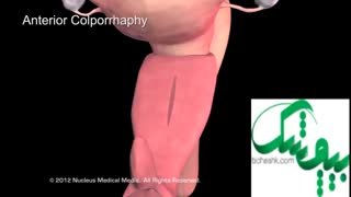 انواع پرولاپس یا افتادگی واژن، علت، علائم و درمان - بیچشک