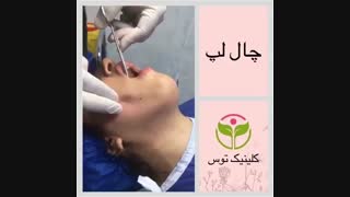 چال لپ
