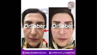 تزریق فیلر جهت لیفت و جوانسازی پروتز سینه