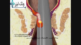 ونک لیزر کلینیک درمان بواسیر به بهترین روش مزوتراپی