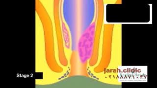 بهترن روش درمان بواسیر در کلینیک نوین https://jarah.clinic/