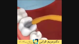 رفع پوسیدگی و ترمیم دندان با کامپوزیت