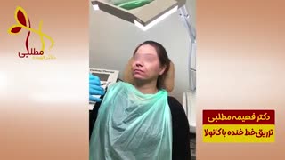 تزریق ژل خط خنده