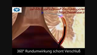 موثرترین درمان فیستول در ونک لیزر https://vanaklaser.ir/