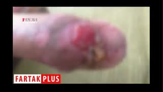 تولید پانسمان از زباله‌های زایمانی در ایران!