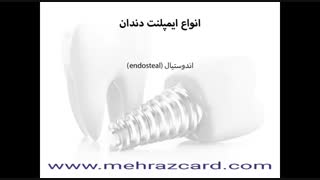 تخفیف ایمپلنت دندان غرب تهران