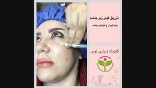 تزریق فیلر زیر چشم در کلینیک توس