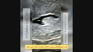 سونوگرافی ترانس واژینال