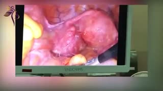 لاپاراسکوپی اندومتریوز و آزاد کردن چسبندگی ها