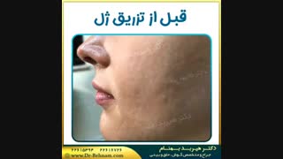 فیلم قبل و بعد از تزریق فیلر لب لیزر مو