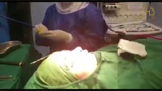 فیلم جراحی بینی در اتاق عمل (قبل و بلافاصله بعد از جراحی)