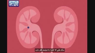 علت سنگ کلیه و راه های درمان آن