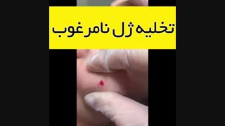 فیلم تخلیه ژل نامرغوب اتوپلاستی