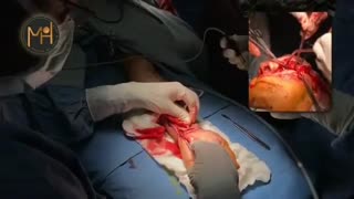 تومور بزرگ چشم