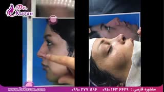 عمل زیبایی بینی توسط دکتر کاوان