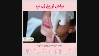 مراحل تزریق ژل لب