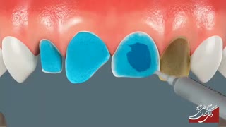 لمینت سرامیکی | دکتر اشکان مصطفی نژاد