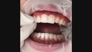 لمینیت سرامیکی | دندانستان