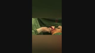 اصلاح پروتز عمل شده توسط جراح دیگر ولیفت سینه همزمان
