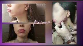 تزریق ژل در چانه