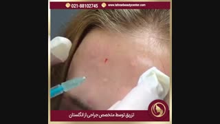 تزریق بوتاکس به صورت چگونه انجام می شود ؟