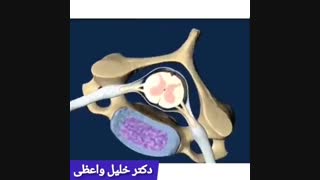 درمان دیسک کمر