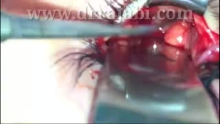 بازسازی شکستگی کاسه چشم با کارگذاری پروتز