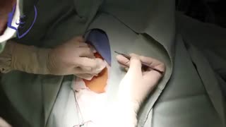 نشت مایع مغزی نخاعی از بینی