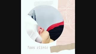 تزریق فیلر و رفع خط خنده
