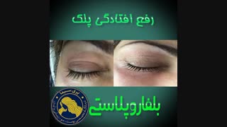 بلفاروپلاستی - دکتر ابدالی -22807060