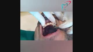 جراحی دندان نیش نهفته