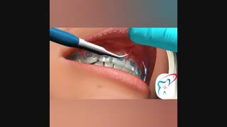 جراحی فرنکتومی