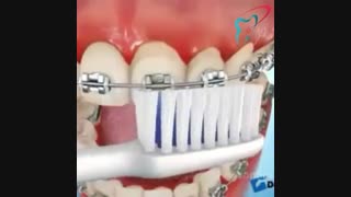 چگونگی مسواک زدن براکت ها در ارتودنسی