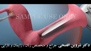 از کجا بفهمیم سرطان رحم داریم؟