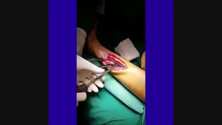 فیلم ترمیم شکستگی ساق پا به همراه پلاک گذاری