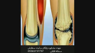 درمان خشکی مفاصل و راه های درمان دیسک کمر