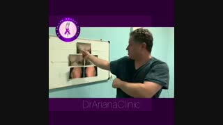 جراحی ترمیم ژنیکوماستی در ورزشکار حرفه ای 29 ساله