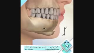 جراحی اصلاح موقعیت چانه | دکتر لادن طیبی برداشتن توده