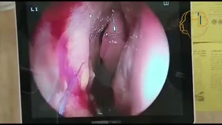 عمل قرینه سازی سوراخ های بینی با آندوسکوپی