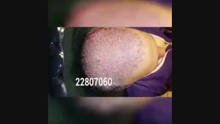 کاشت مو - دکتر ابدالی - 22807060