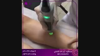 جلسات لیزر موهای زائد پالپوتومی