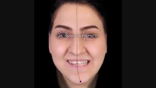 درمان ارتودنسی توام با جراحی فک | دندانستان