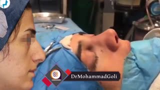 انتهای عمل بینی | دکتر گلی