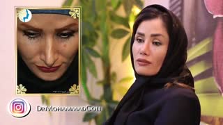 یک سال پس از جراحی بینی | دکتر گلی