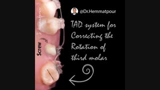 تصحیح چرخش دندان مولر سوم | دندانستان