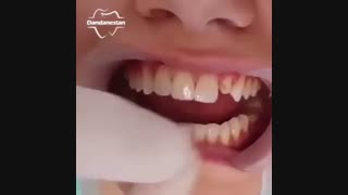 لامینیت دندان | دندانستان