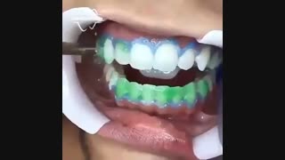 بلیچینگ دندان | دندانستان